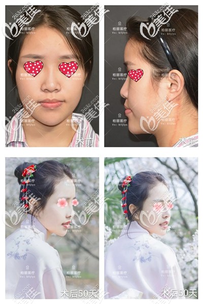 找李勁良醫(yī)生隆鼻前后對比 找李勁良醫(yī)生隆鼻前后對比