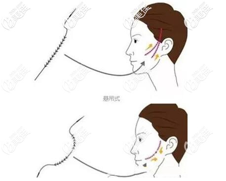 埋線提升的埋入位置 埋線提升的埋入位置