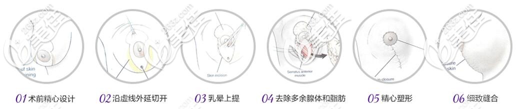 垂直切口法乳房縮小術(shù)示意圖 垂直切口法乳房縮小術(shù)示意圖