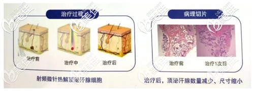 黃金微針治療狐臭的原理和效果