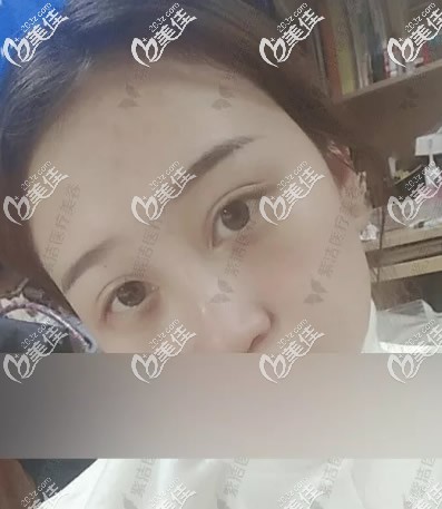 赤峰紫潔劉文峰不開刀去眼袋第3天