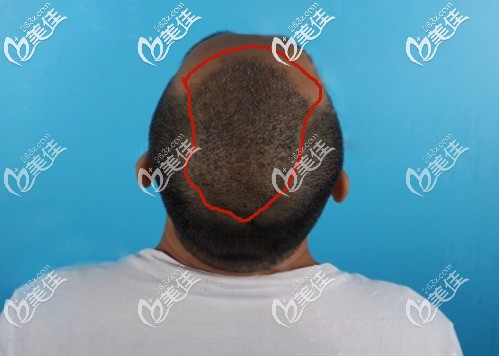 頭發(fā)加密手術(shù)術(shù)后8天效果