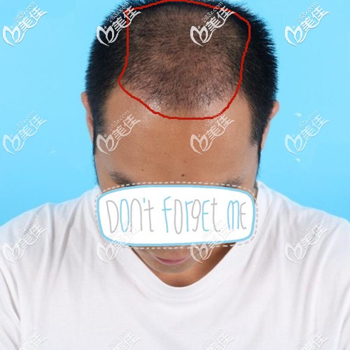 廣州倍生頭發(fā)加密種植一個(gè)月效果