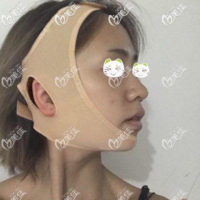 做顴骨整形半個月后還戴著頭套
