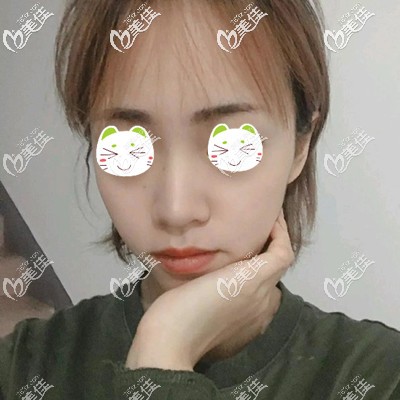 做完顴骨手術(shù)的恢復(fù)經(jīng)歷中透露了內(nèi)推后會不會存在有骨縫的后遺癥