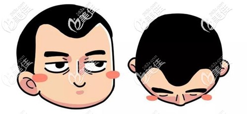 m型脫發(fā)、發(fā)際線后移