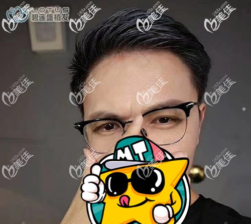 竟然這樣應對我的m型脫發(fā)—在發(fā)際線處種植了1600毛囊單位！