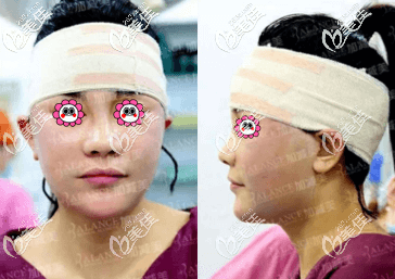 做完V美減齡術(shù)后當(dāng)天