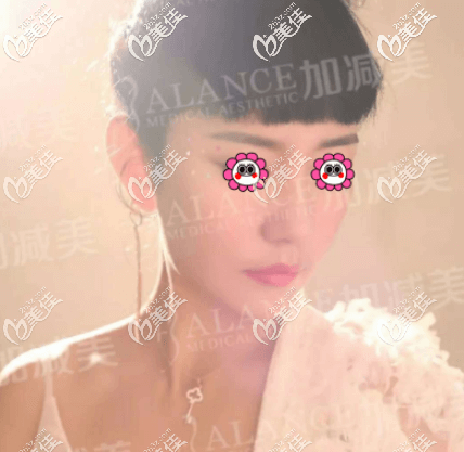 做了V美減齡面部提升有三個(gè)月了