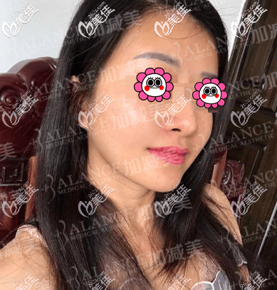 做V美減齡提升抗衰一個(gè)月樣子 做V美減齡提升抗衰一個(gè)月樣子