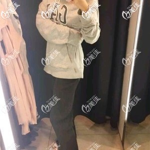 吸脂瘦大腿術(shù)后32天腫脹漸消 吸脂瘦大腿術(shù)后32天腫脹漸消