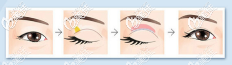 深圳瑞芙臣劉顏顏醫(yī)生雙眼皮手術(shù)過程演示 深圳瑞芙臣劉顏顏醫(yī)生雙眼皮手術(shù)過程演示