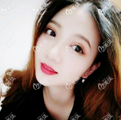 深圳瑞芙臣不僅正規(guī)又靠譜,劉顏顏醫(yī)生的雙眼皮技術(shù)更是了得