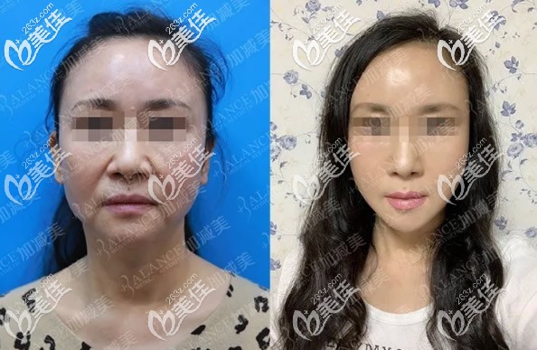 北京加減美穆寶安面部提升效果案例 北京加減美穆寶安面部提升效果案例