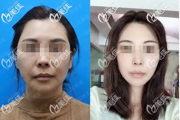 加減美v6提升一個(gè)月效果圖 加減美v6提升一個(gè)月效果圖