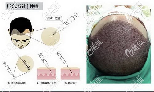 微針植發(fā)原理及效果展示