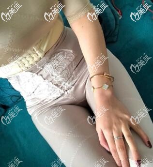 我在貴陽華美做完吸脂手術(shù)半個月了