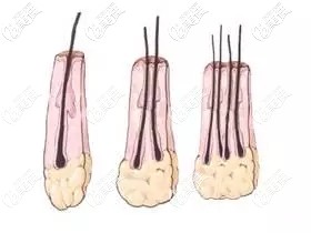 一個毛囊里有1-4根頭發(fā)