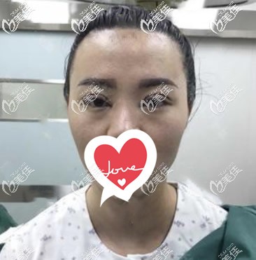 蘭州時光相伴整形全切7毫米雙眼皮術(shù)后即刻