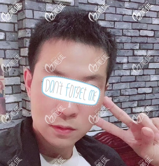 前額角脫發(fā)植發(fā)3個(gè)月效果圖自拍!順便給大家講講植發(fā)4天后如何清洗血痂