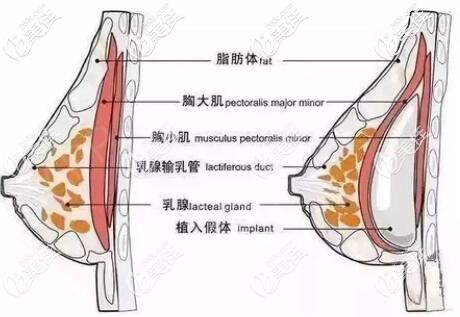 假體隆胸手術(shù)剝離位置 假體隆胸手術(shù)剝離位置