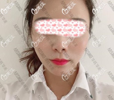 在長沙華韓華美做的M唇不僅效果好，而且價格也很公道，給大家看下恢復(fù)后的圖片吧！