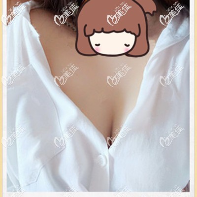 術(shù)后一個(gè)月恢復(fù)的不錯(cuò) 術(shù)后一個(gè)月恢復(fù)的不錯(cuò)