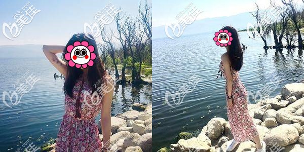 胳膊吸脂7天恢復(fù)圖，親身體驗(yàn)來(lái)說(shuō)并沒(méi)有大家說(shuō)的好痛苦、爆腫、手臂沒(méi)變細(xì)的情況