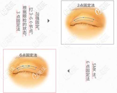 永井醫(yī)生的埋線雙眼皮和傳統(tǒng)埋線法的區(qū)別 永井醫(yī)生的埋線雙眼皮和傳統(tǒng)埋線法的區(qū)別