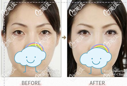 術(shù)前單眼皮選擇埋線做平行雙眼皮 術(shù)前單眼皮選擇埋線做平行雙眼皮