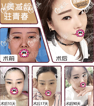 我找北京加減美黃寅守做V美減齡v6面部提升效果 我找北京加減美黃寅守做V美減齡v6面部提升效果