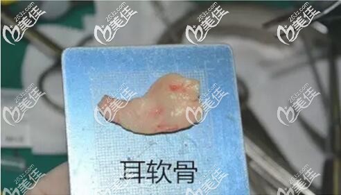 取下來的耳軟骨 取下來的耳軟骨