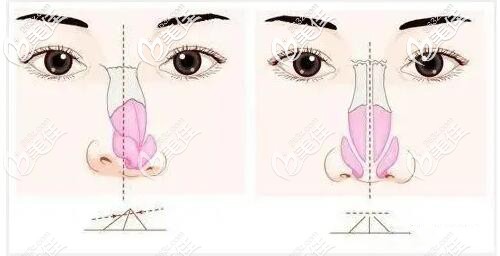 歪鼻矯正手術(shù)原理 歪鼻矯正手術(shù)原理