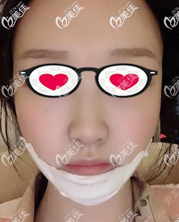 硅膠墊下巴第1天摸著很僵硬 硅膠墊下巴第1天摸著很僵硬