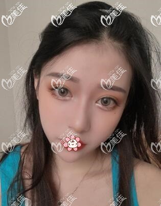 醫(yī)生說我眼瞼皮膚緊致不適合外切法，內(nèi)切祛眼袋+眶隔脂肪釋放填充淚溝才適合我