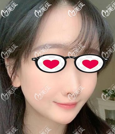 下巴后縮的我用韓士生科硅膠墊下巴兩個(gè)月后,說話沒有僵硬的拉扯感假體也沒有移位和透光!