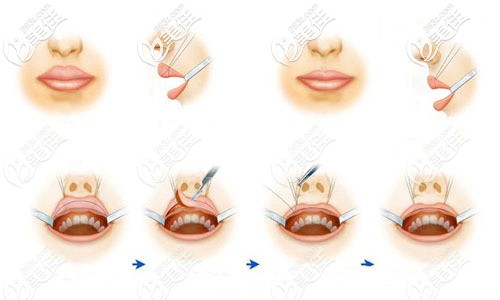厚唇改薄手術(shù)過(guò)程 厚唇改薄手術(shù)過(guò)程