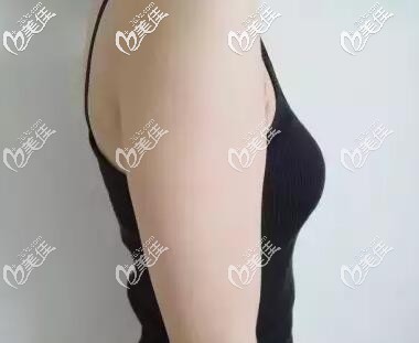 手臂吸脂術前照 手臂吸脂術前照