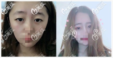 劉晉元雙眼皮真人案例效果對比圖 劉晉元雙眼皮真人案例效果對比圖