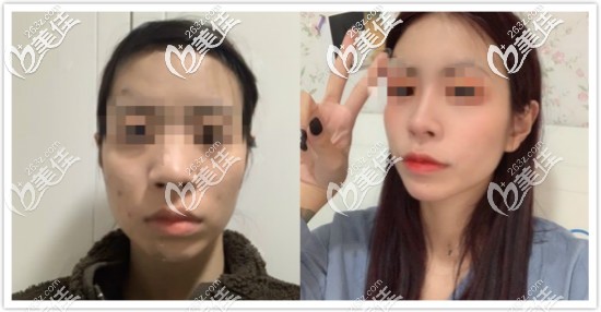 太原劉晉元肋軟骨隆鼻6個月效果對比照片 太原劉晉元肋軟骨隆鼻6個月效果對比照片