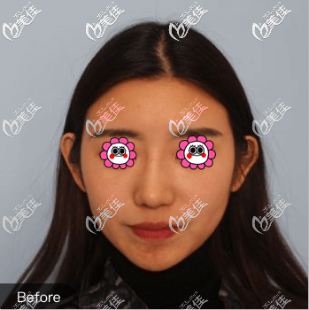 做玻尿酸墊下巴前樣子 做玻尿酸墊下巴前樣子