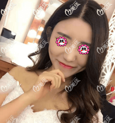 我在北京藝星做玻尿酸注射下巴一周了 我在北京藝星做玻尿酸注射下巴一周了