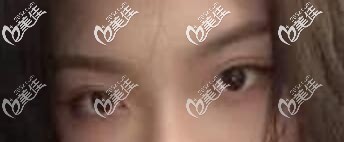 蘇州康美整形張悅迪雙眼皮真人案例 蘇州康美整形張悅迪雙眼皮真人案例