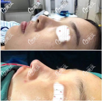 說鼻綜合不如單純隆鼻好看的那肯定是沒看過池州靈創(chuàng)這家醫(yī)院給出的三組自體軟骨隆鼻案例