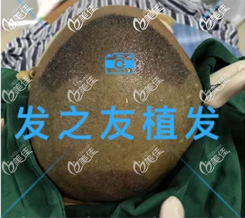 ?植發(fā)頭頂加密和發(fā)際線進行!分享南寧發(fā)之友微針植發(fā)3500單位效果圖