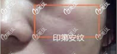 印第安紋形成原因 印第安紋形成原因