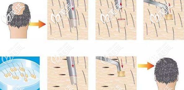植發(fā)手術(shù)原理過程示意圖