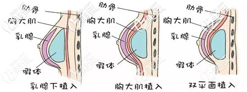 20200525_1590390195439334.jpg 假體隆胸.jpg