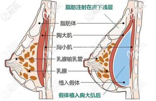 復(fù)合式隆胸的手術(shù)原理 復(fù)合式隆胸的手術(shù)原理