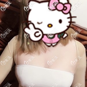 復(fù)合式隆胸術(shù)后即刻胸部變大 復(fù)合式隆胸術(shù)后即刻胸部變大